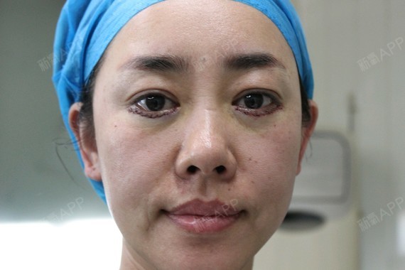 北京内切去眼袋好不好_效果图_涵树姐姐内切去眼袋术后第0天_新氧美容