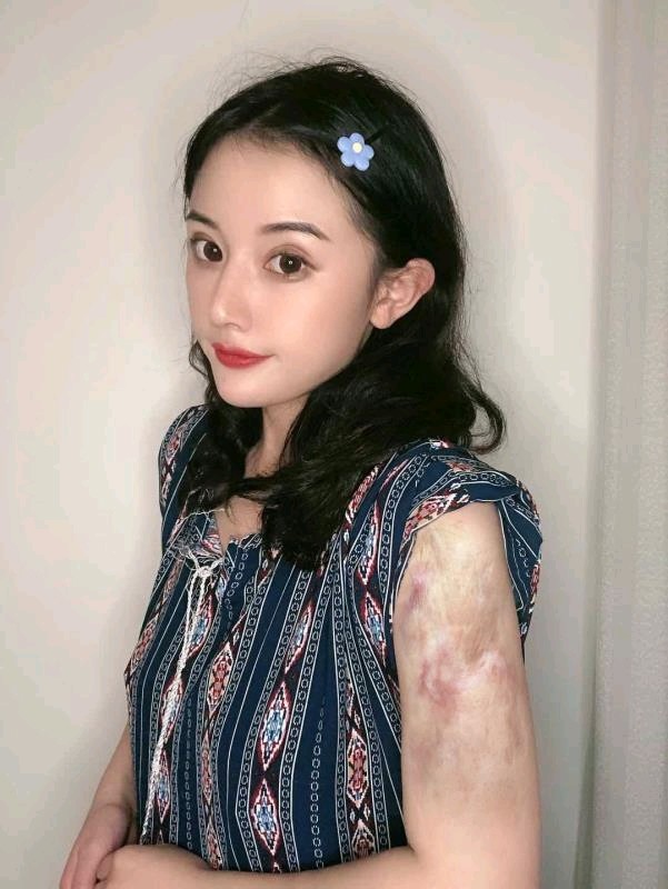 无创疤痕修复第0天