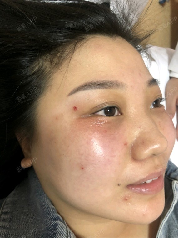 今天我做的是点阵激光点疣和超皮秒两个项目,我就都放_圈子-新氧美容