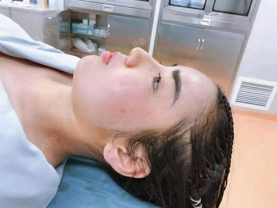 假体填充额头
