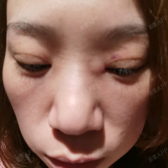 有没有专业人士能回答一下,我这是开眼角失败了吗?