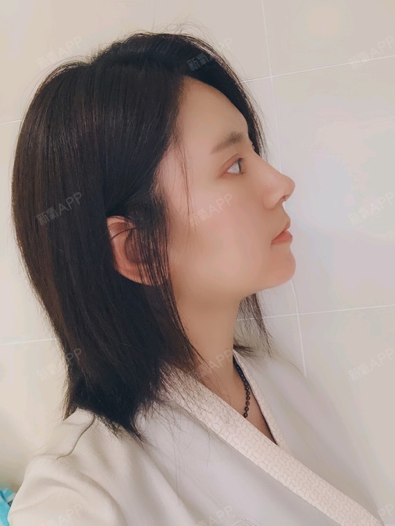 深圳耳软骨复合隆鼻好不好_效果图_a小鱼1耳软骨复合隆鼻术后第7天