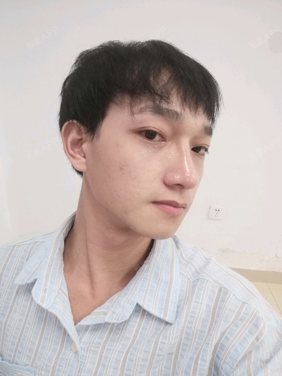 鼻部多项好不好_效果图_氧气zsbjj鼻部多项术后第88天_新氧美容整形