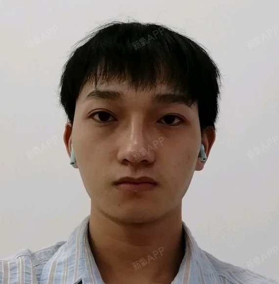 鼻部多项好不好_效果图_氧气zsbjj鼻部多项术后第88天_新氧美容整形