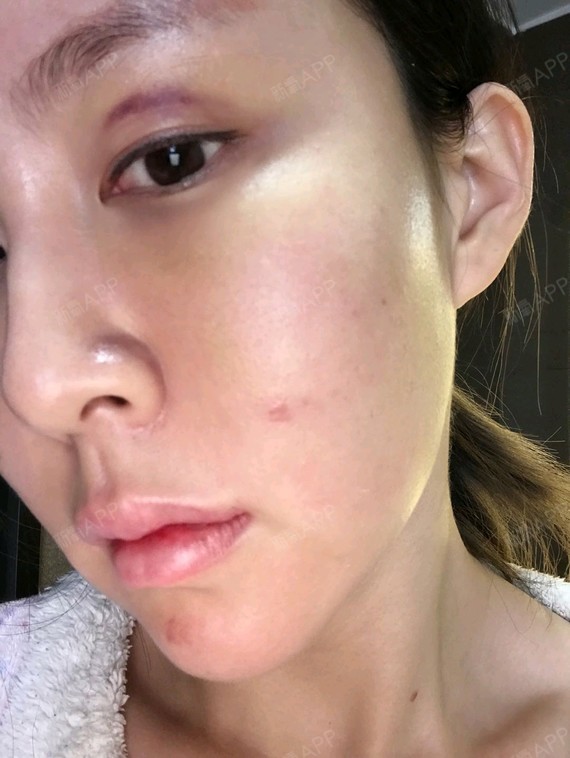 童颜针好不好_效果图_范范范小雨童颜针术后第6天_新氧美容整形
