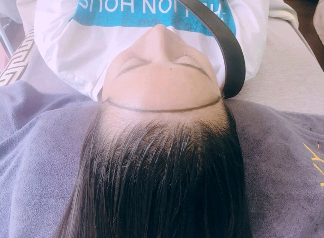 半永久纹发际线第4天