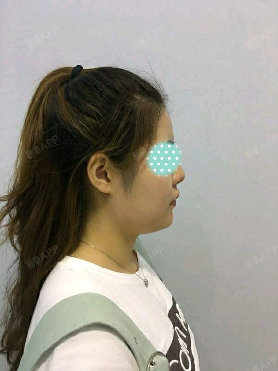 硅胶隆鼻