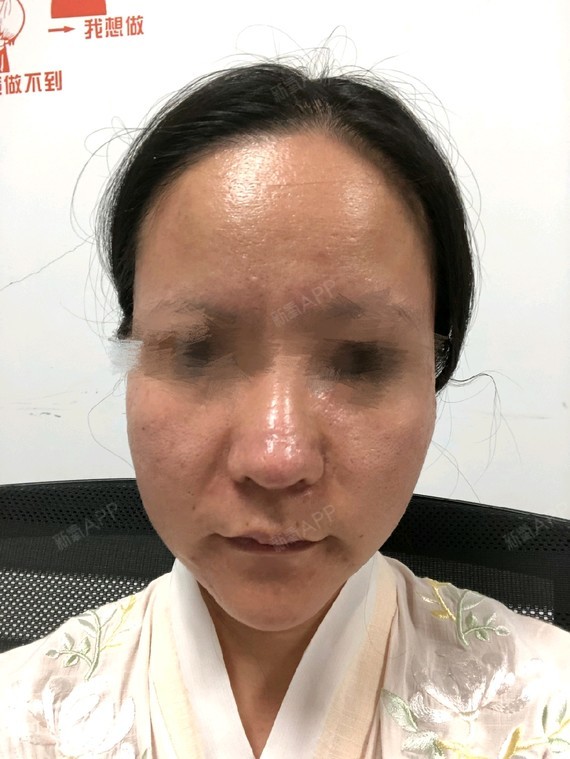昨天做了舒敏,和彩光,脸有点犯红