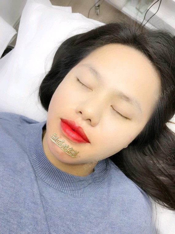 通过新氧消费方案查看半永久纹唇微创轻度疼痛唇型美化