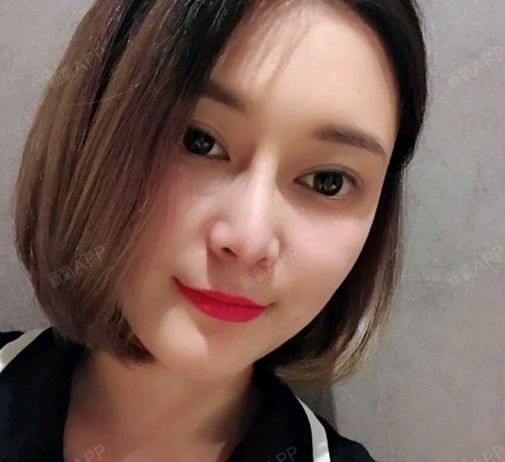 玻尿酸隆鼻七天了,给大家看看效果,必须笔芯罗谦医生,非常靠谱