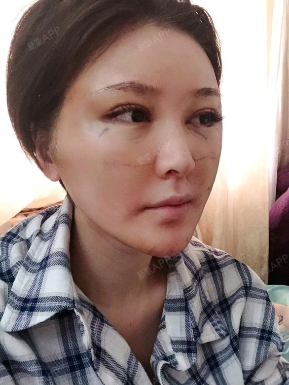 自体脂肪填充卧蚕