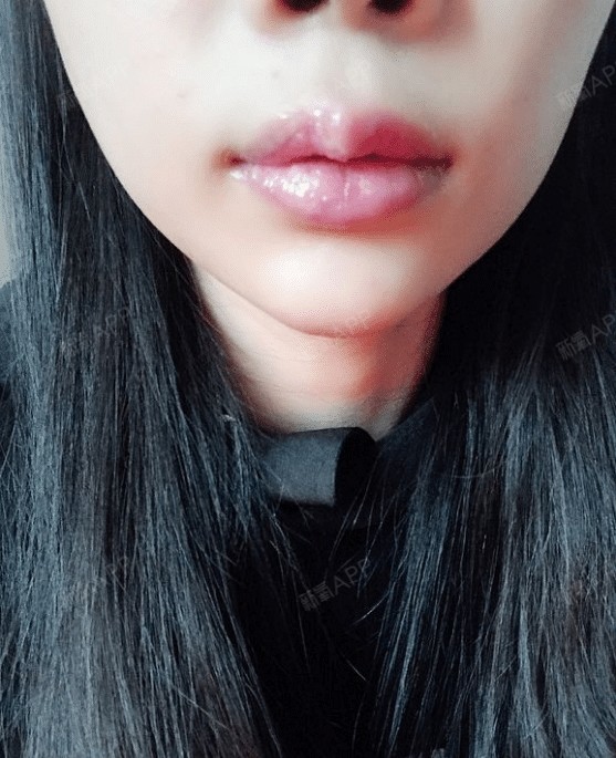 唇部的形态也基本上出来了!不过还有一点痕迹,等后面恢复好了就行