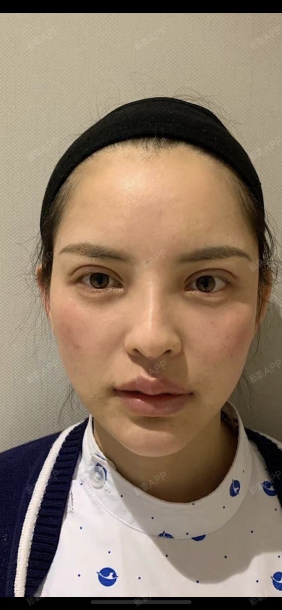 上海玻尿酸丰唇好不好_效果图_氧气xk3cg玻尿酸丰唇术后第1天_新氧