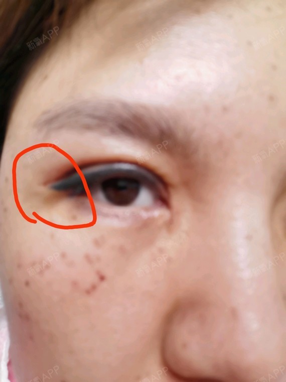眼尾沟手术图片