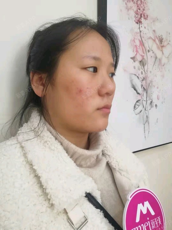 武汉伊肤泉微针好不好_效果图_氧气2vkpn伊肤泉微针术后第0天_新氧