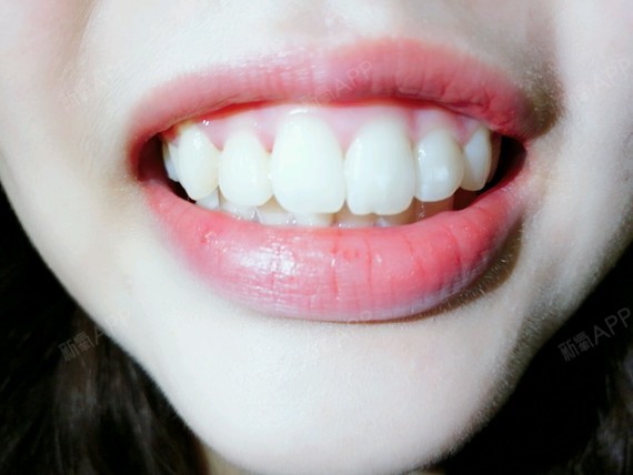 我的牙齿情况是:右下5号牙长错位到6号牙位置,并且_圈子-新氧美容整形