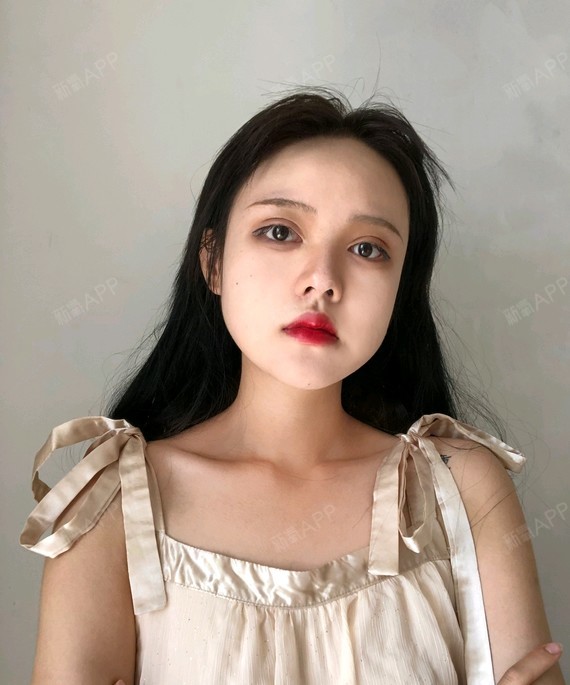 重庆玻尿酸丰卧蚕好不好_效果图_氧气45gx1玻尿酸丰卧蚕术后第26天