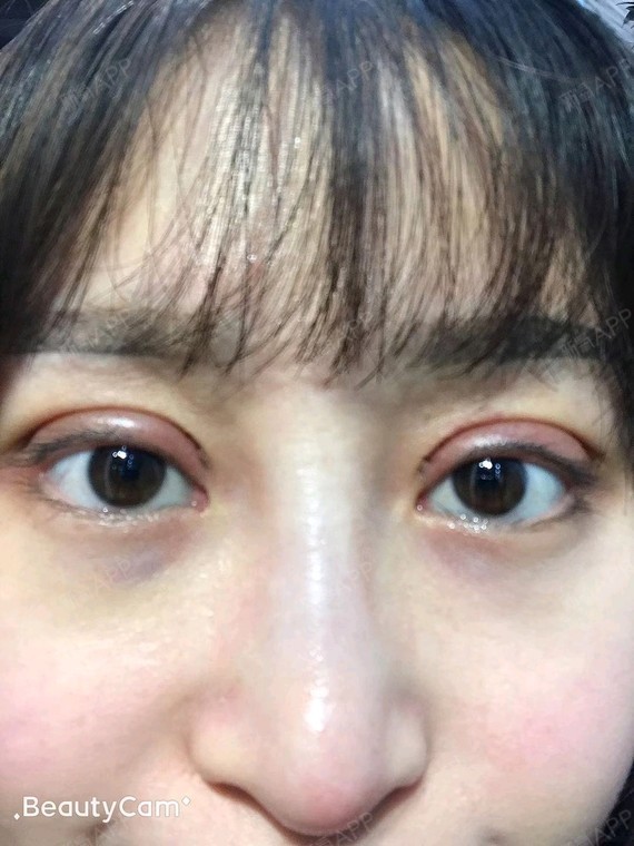 全切双眼皮术后第三天,有消肿的迹象了!肿到不_圈子-新氧美容整形