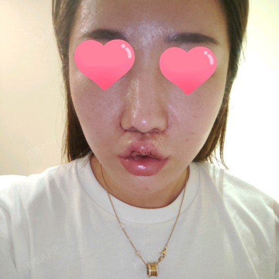 人中缩短术