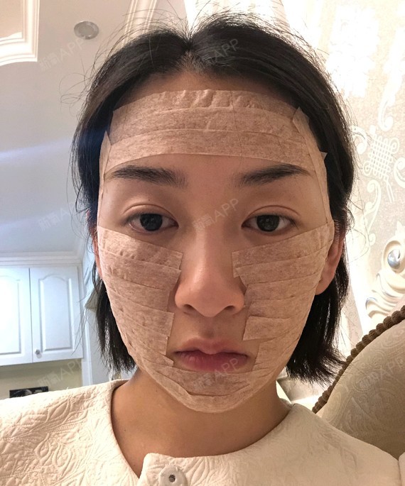 自体脂肪填充全脸