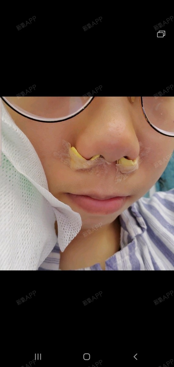 感觉还行就是鼻子里面塞着棉花好难受