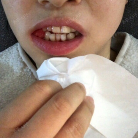 30岁,嘴巴自然闭合不上,嘴凸,下牙不整齐,长期口_圈子-新氧美容整形
