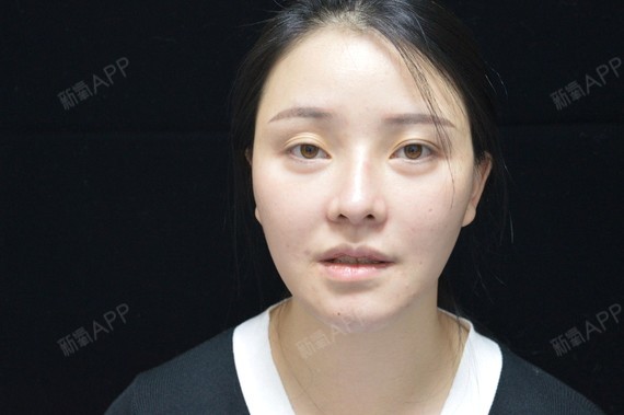 双侧颧弓脂肪有点多,显得两侧颧骨很高,面部显宽,于_圈子-新氧美容