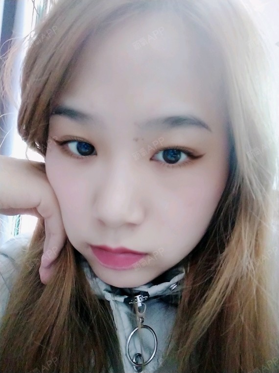 面部吸脂好不好_效果图_喵呜⑤面部吸脂术后第21天_新氧美容整形