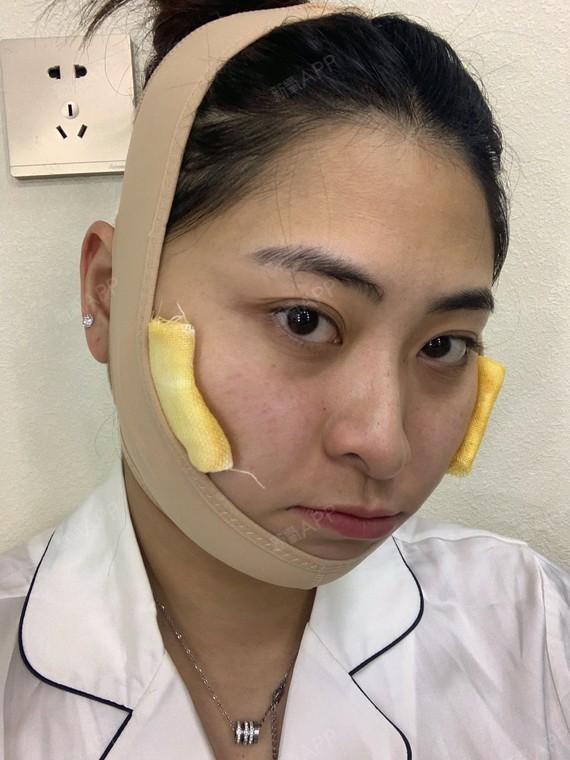 下颌角整形