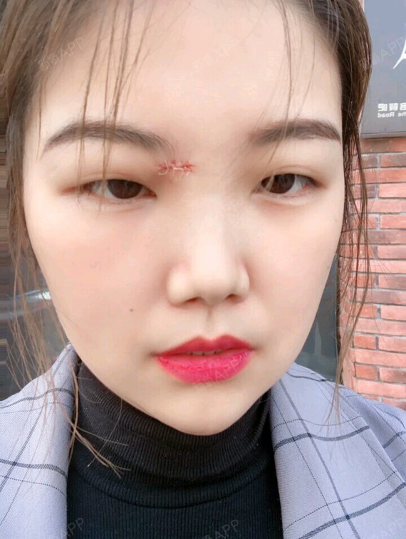 眉头上的疤痕特别明显,而且我觉得已经影响到我的生活_圈子-新氧美容