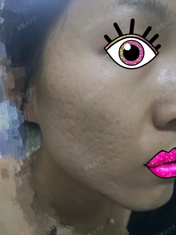 微针美塑好不好_效果图_氧气滴佳仁微针美塑术后第0天_新氧美容整形