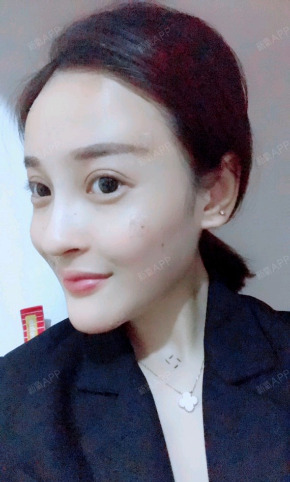 自体脂肪填充卧蚕