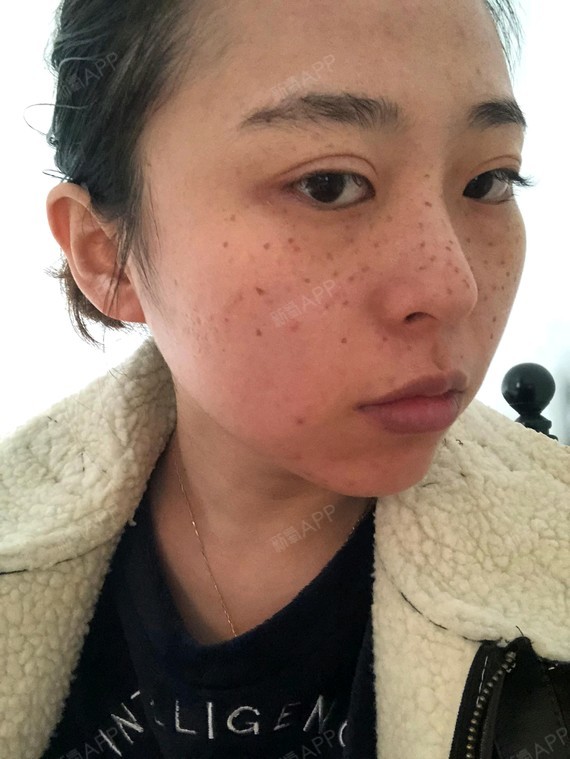 做的第3天了,点斑的地方已经结痂了,现在就是等待痂_圈子-新氧美容