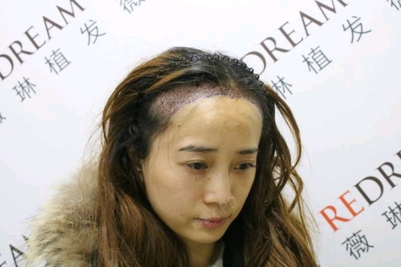 天生发际线就比较高,而且比较杂乱,再加上额角两边头_圈子-新氧美容