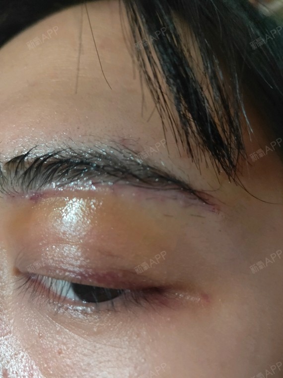 今天第七天,拆线了,该买的去疤产品也买好了,术后每天可以用生理盐水