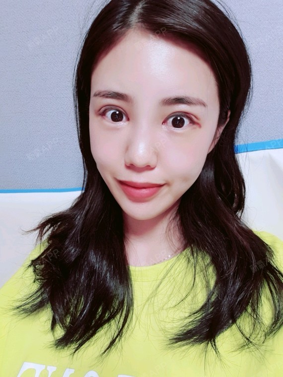 切开双眼皮好不好_效果图_一杯意式切开双眼皮术后第15天_新氧美容