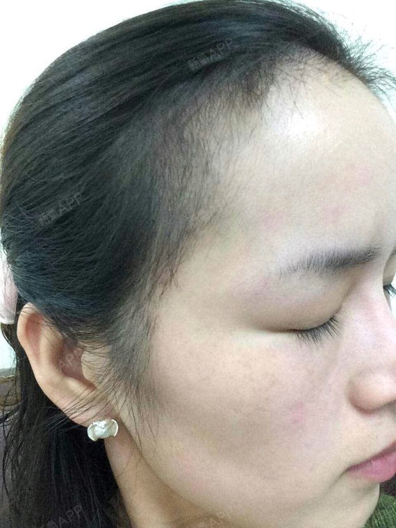 快四个月了,小头发长的挺快的,绒毛感也特别好,前几_圈子-新氧美容