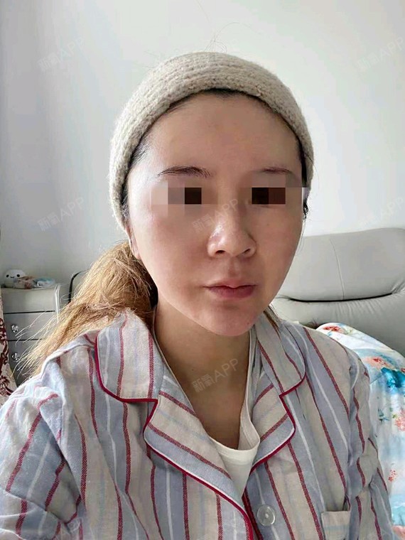 拉皮手术提升好不好_效果图_莫文文拉皮手术提升术后第7天_新氧美容