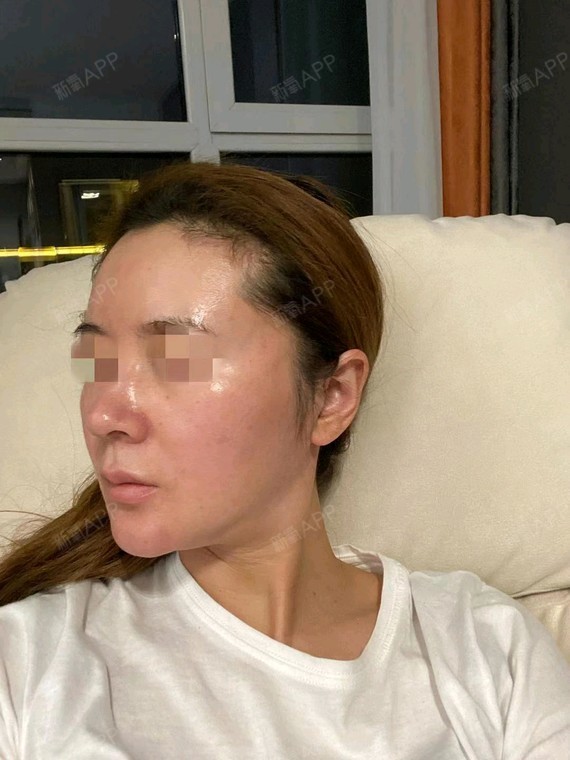 拉皮手术提升好不好_效果图_莫文文拉皮手术提升术后第15天_新氧美容