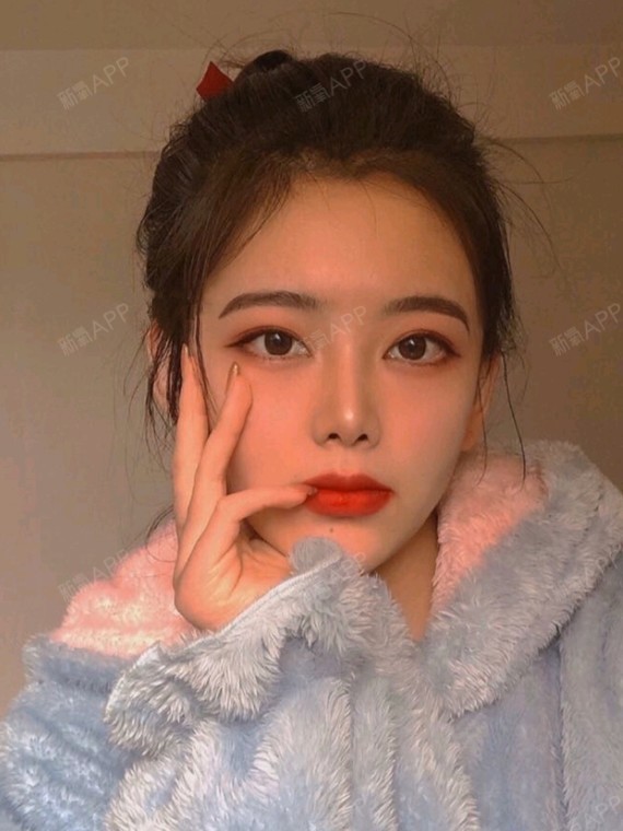 双眼皮五个月分享!割的7mm,形状扇形 一点平行!_圈子-新氧美容整形