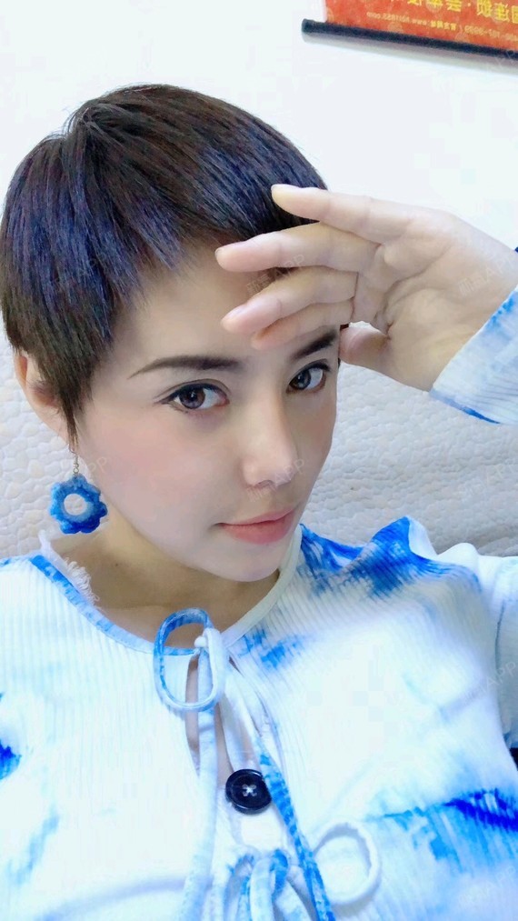 鼻基底好不好_效果图_氧气4le6b假体垫鼻基底术后第68天_新氧美容整形