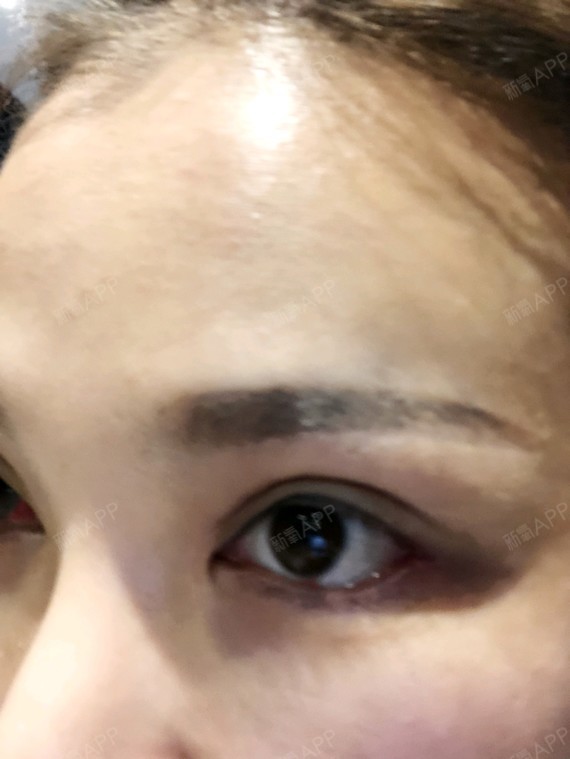 眼睑下至外眼角术后2天