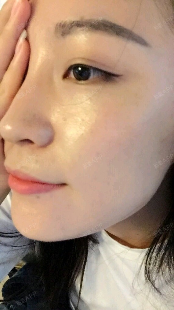 玻尿酸丰鼻基底