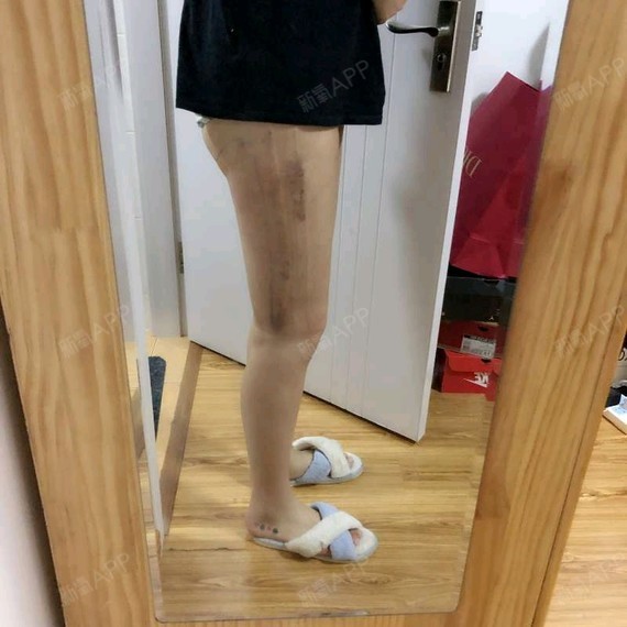 冷冻溶脂瘦腰部好不好_效果图_小喵喵爱吃冷冻溶脂瘦腰部术后第7天