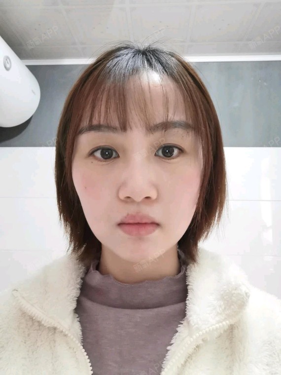 哒哒哒,这是我第七天的样子啦,刚开始填充完的时候,_圈子-新氧美容