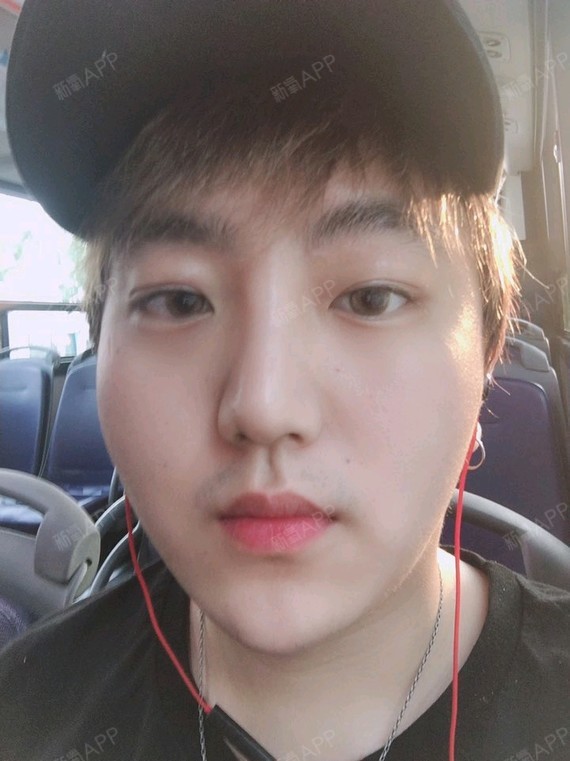 埋线双眼皮好不好_效果图_一个帅男埋线双眼皮术后第36天_新氧美容