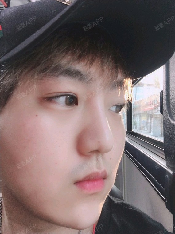 埋线双眼皮好不好_效果图_一个帅男埋线双眼皮术后第36天_新氧美容