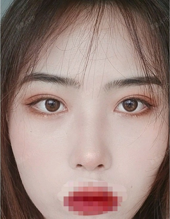 相较于其他双眼皮,韩式三点恢复得较快,也更自然,满意违法和不良邢ⅱ