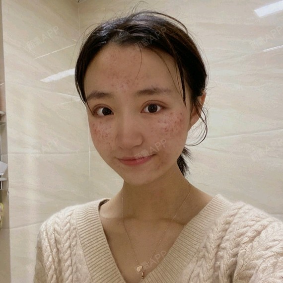 我这种痘疤痘印脸,真的是不能看(捂脸哭),只能怪皮_圈子-新氧美容整形