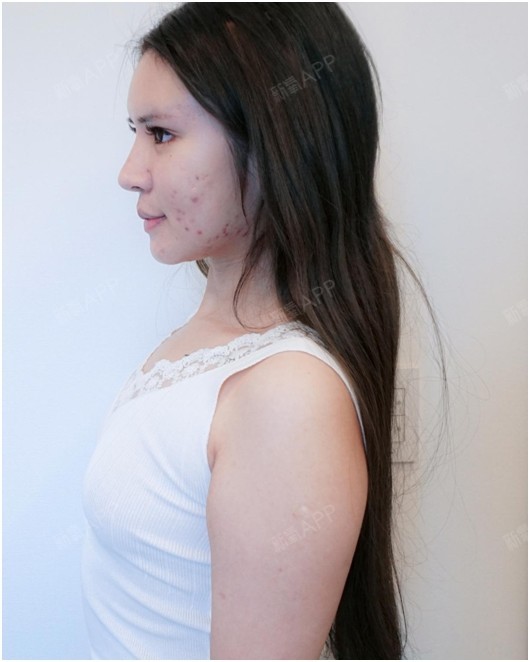 假体隆胸好不好_效果图_不想跳舞假体隆胸术后第0天_新氧美容整形